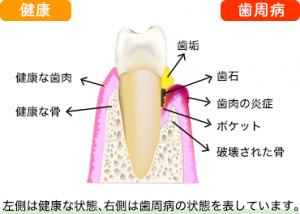 歯周病の説明